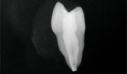 Radiograph showing the bucco-lingual aspect of the maxillary first premolar